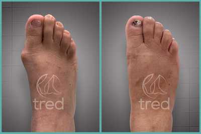 Bunion Removal
